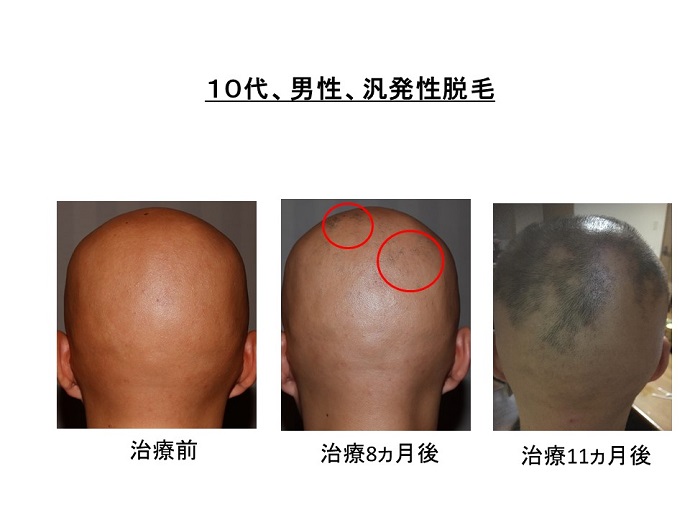 円形脱毛症　病院